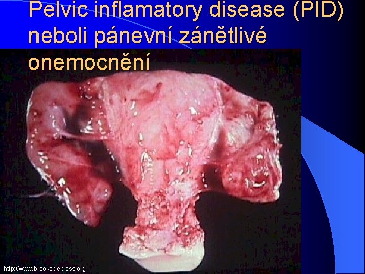 Pelvic inflamatory disease (PID) neboli pánevní zánětlivé onemocnění http: //www. brooksidepress. org 