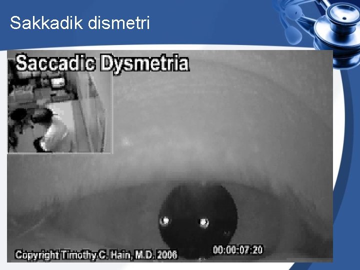 Sakkadik dismetri 