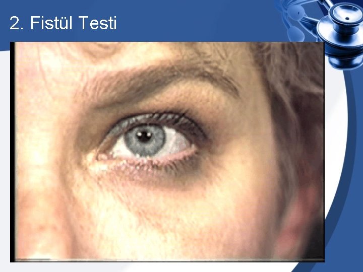 2. Fistül Testi 