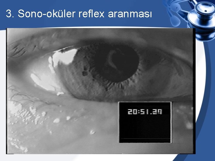 3. Sono-oküler reflex aranması 