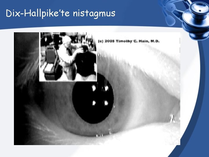 Dix-Hallpike’te nistagmus 