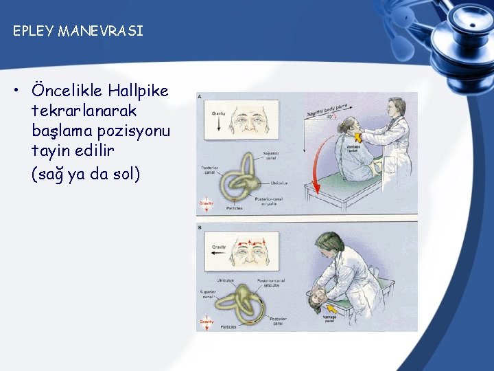 EPLEY MANEVRASI • Öncelikle Hallpike tekrarlanarak başlama pozisyonu tayin edilir (sağ ya da sol)