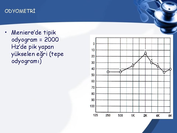 ODYOMETRİ • Meniere’de tipik odyogram = 2000 Hz’de pik yapan yükselen eğri (tepe odyogramı)