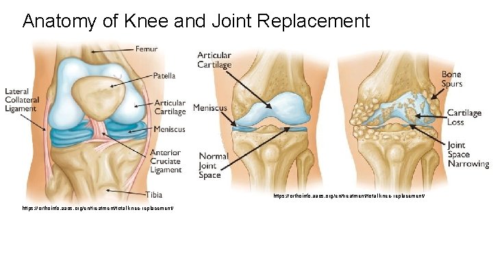 Anatomy of Knee and Joint Replacement https: //orthoinfo. aaos. org/en/treatment/total-knee-replacement/ 