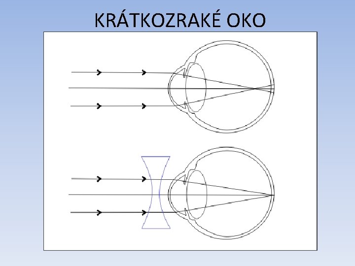 KRÁTKOZRAKÉ OKO 