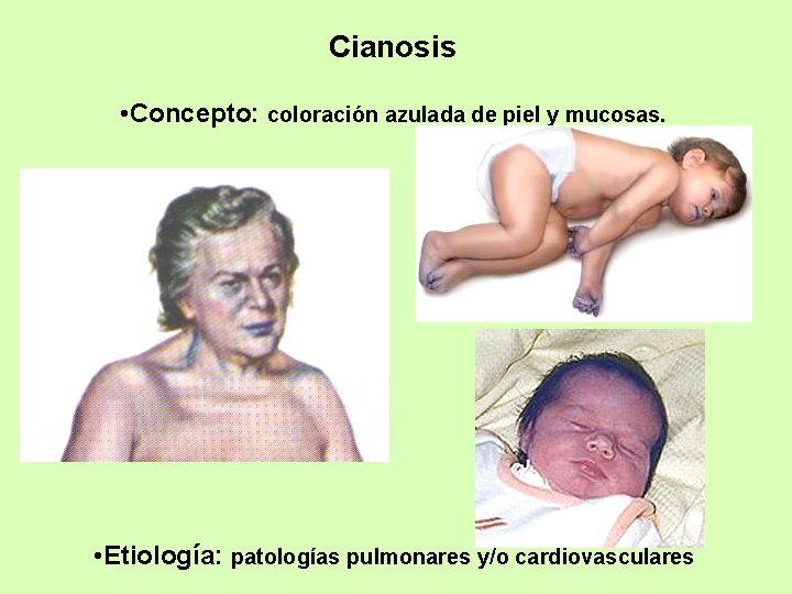 Cianosis • Concepto: coloración azulada de piel y mucosas. • Etiología: patologías pulmonares y/o