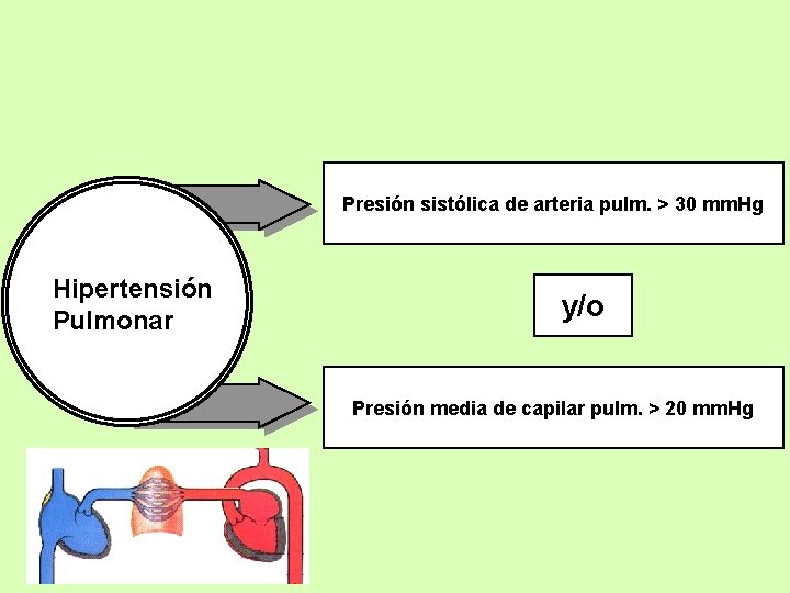 Presión sistólica de arteria pulm. > 30 mm. Hg Hipertensión Pulmonar y/o Presión media