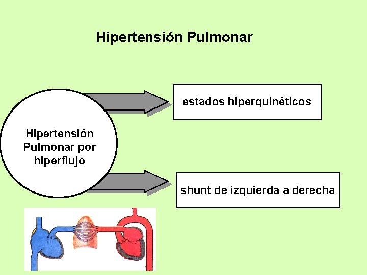 Hipertensión Pulmonar estados hiperquinéticos Hipertensión Pulmonar por hiperflujo shunt de izquierda a derecha 