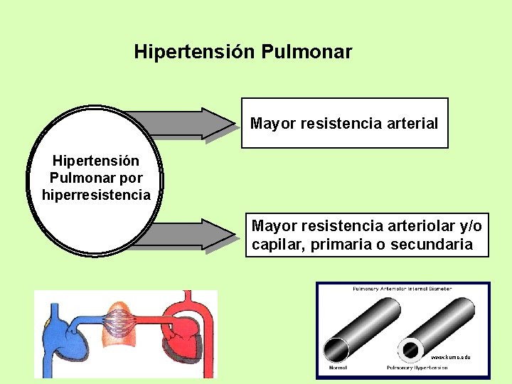 Hipertensión Pulmonar Mayor resistencia arterial Hipertensión Pulmonar por hiperresistencia Mayor resistencia arteriolar y/o capilar,
