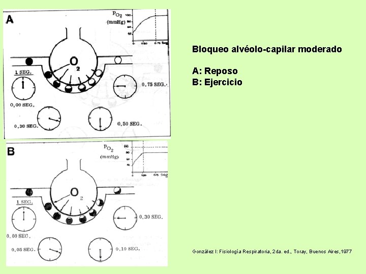 Bloqueo alvéolo-capilar moderado A: Reposo B: Ejercicio González I: Fisiología Respiratoria, 2 da. ed.