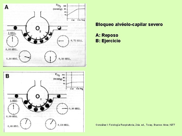Bloqueo alvéolo-capilar severo A: Reposo B: Ejercicio González I: Fisiología Respiratoria, 2 da. ed.