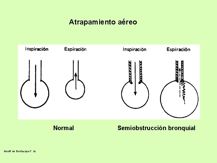 Atrapamiento aéreo Normal Modif. de Bevilacqua F. id. Semiobstrucción bronquial 