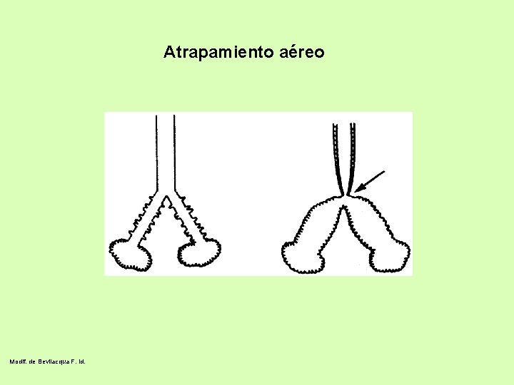 Atrapamiento aéreo Modif. de Bevilacqua F. id. 