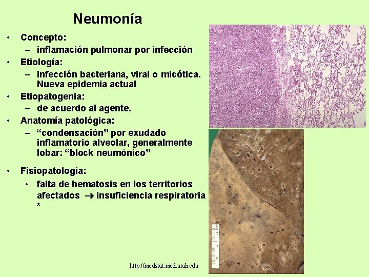 Neumonía • • • Concepto: – inflamación pulmonar por infección Etiología: – infección bacteriana,