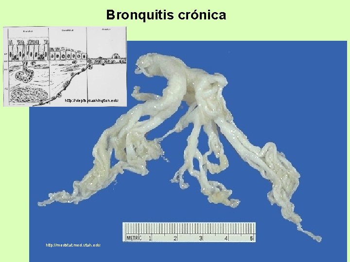 Bronquitis crónica http: //depts. washington. edu http: //medstat. med. utah. edu 