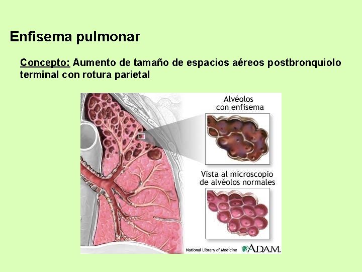 Enfisema pulmonar Concepto: Aumento de tamaño de espacios aéreos postbronquiolo terminal con rotura parietal