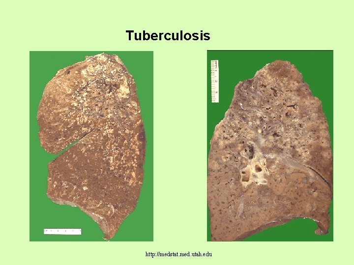 Tuberculosis http: //medstat. med. utah. edu 