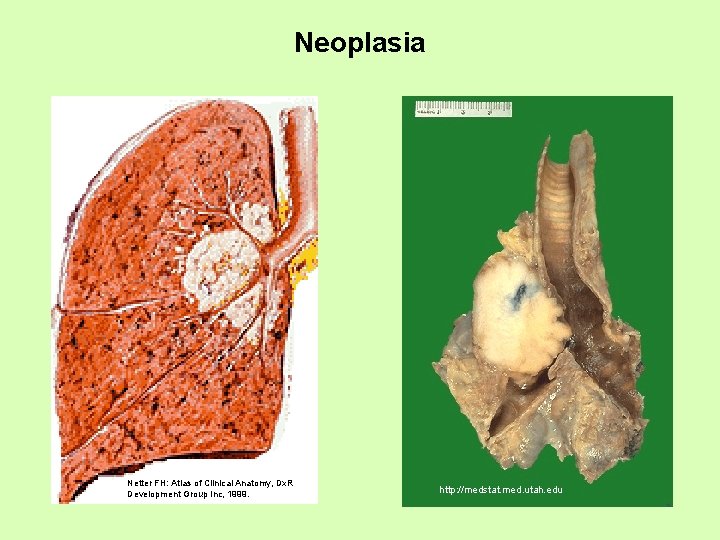 Neoplasia Netter FH: Atlas of Clinical Anatomy, Dx. R Development Group Inc, 1999. http: