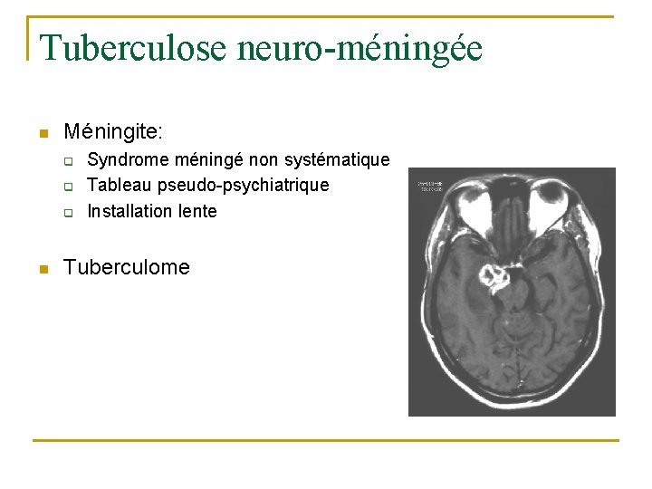 Tuberculose neuro-méningée n Méningite: q q q n Syndrome méningé non systématique Tableau pseudo-psychiatrique