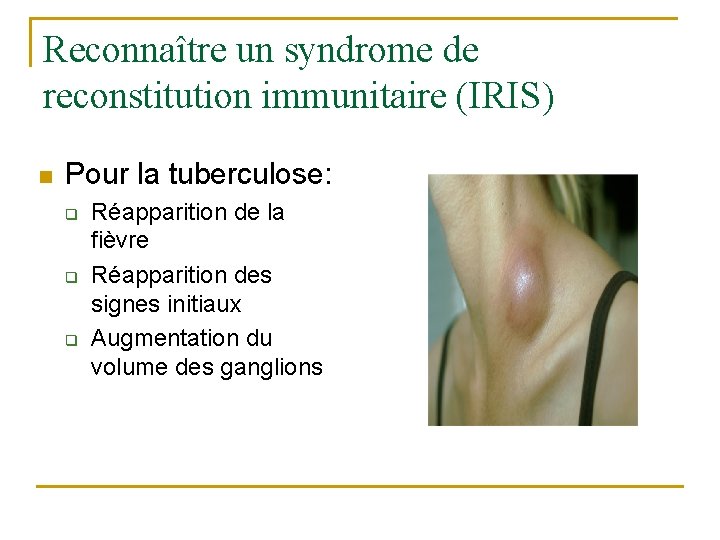 Reconnaître un syndrome de reconstitution immunitaire (IRIS) n Pour la tuberculose: q q q