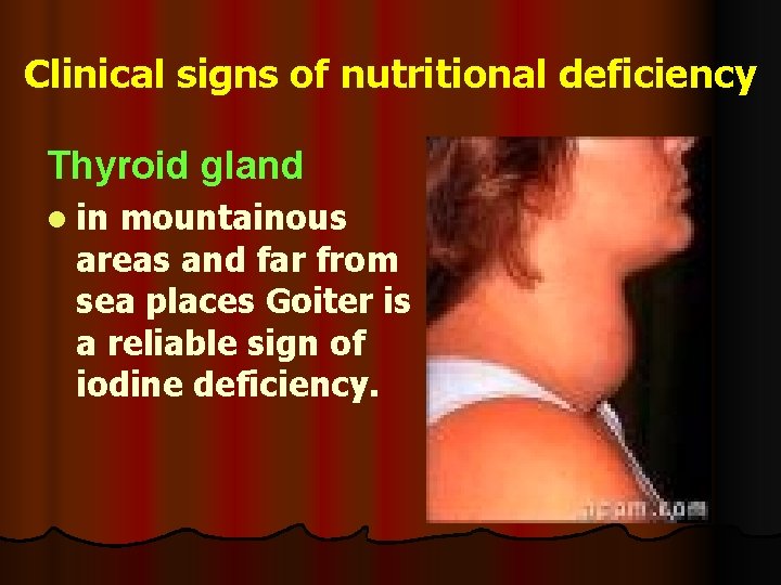 Clinical signs of nutritional deficiency Thyroid gland l in mountainous areas and far from