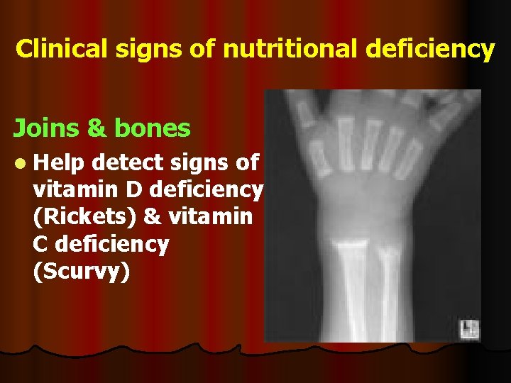 Clinical signs of nutritional deficiency Joins & bones l Help detect signs of vitamin