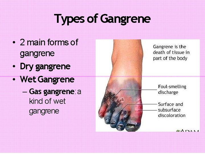 Types of Gangrene • 2 main forms of gangrene • Dry gangrene • Wet