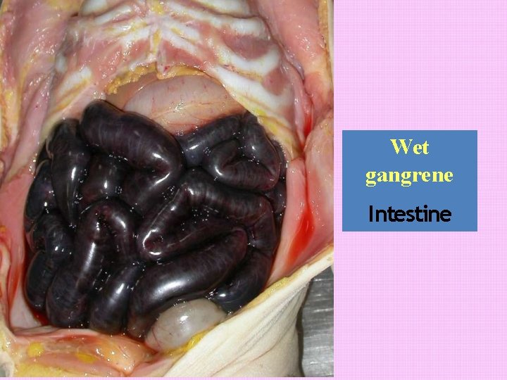 Wet gangrene Intestine 