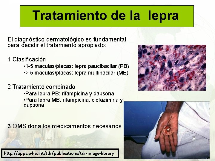 Tratamiento de la lepra El diagnóstico dermatológico es fundamental para decidir el tratamiento apropiado:
