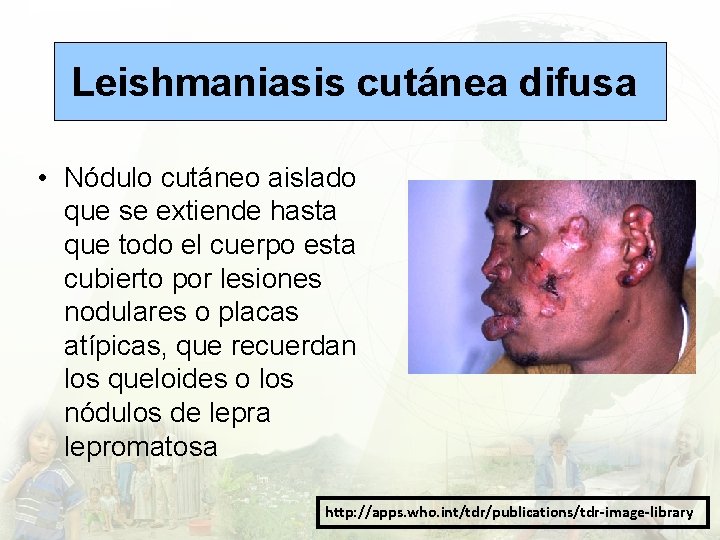 Leishmaniasis cutánea difusa • Nódulo cutáneo aislado que se extiende hasta que todo el