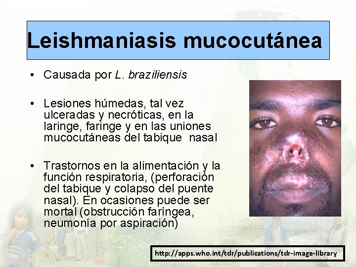 Leishmaniasis mucocutánea • Causada por L. braziliensis • Lesiones húmedas, tal vez ulceradas y