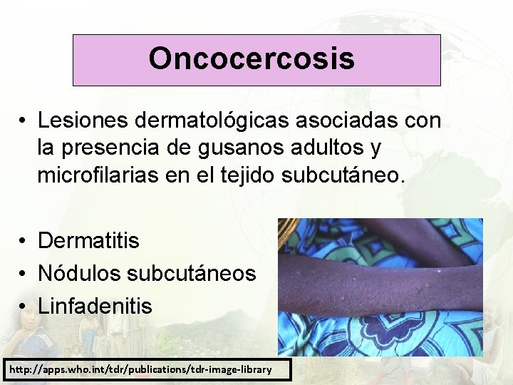 Oncocercosis • Lesiones dermatológicas asociadas con la presencia de gusanos adultos y microfilarias en