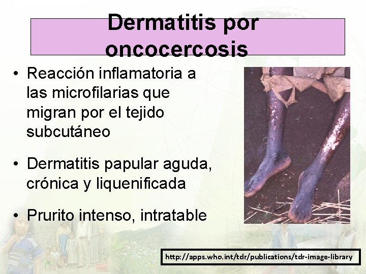 Dermatitis por oncocercosis • Reacción inflamatoria a las microfilarias que migran por el tejido