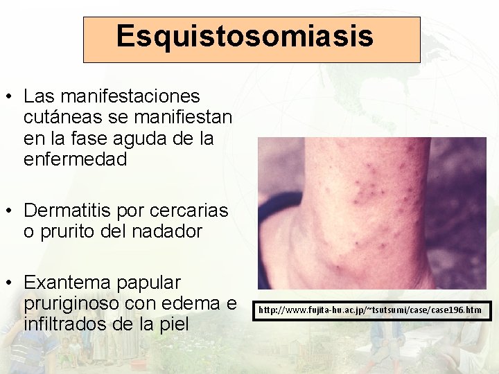 Esquistosomiasis • Las manifestaciones cutáneas se manifiestan en la fase aguda de la enfermedad