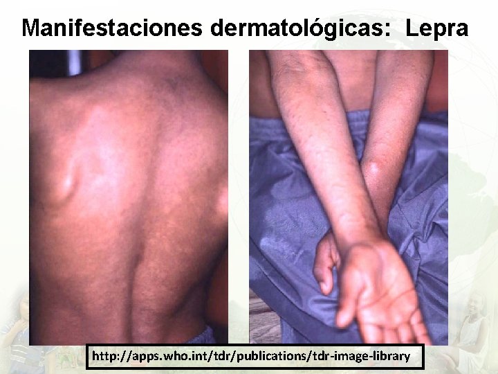 Manifestaciones dermatológicas: Lepra http: //apps. who. int/tdr/publications/tdr-image-library 