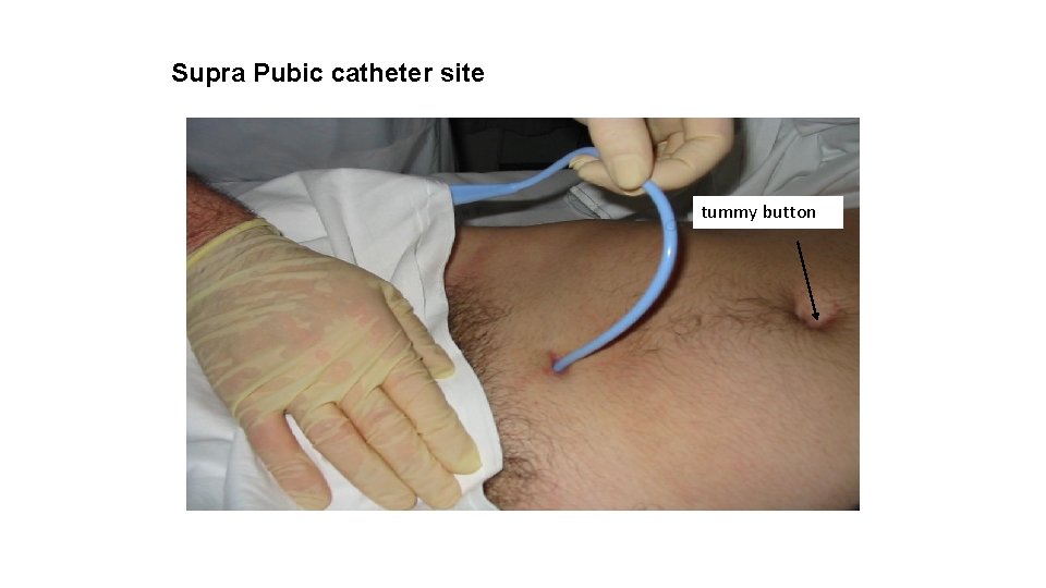 Supra Pubic catheter site tummy button 