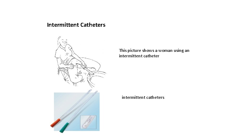 Intermittent Catheters This picture shows a woman using an intermittent catheters 