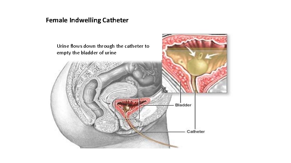 Female Indwelling Catheter Urine flows down through the catheter to empty the bladder of