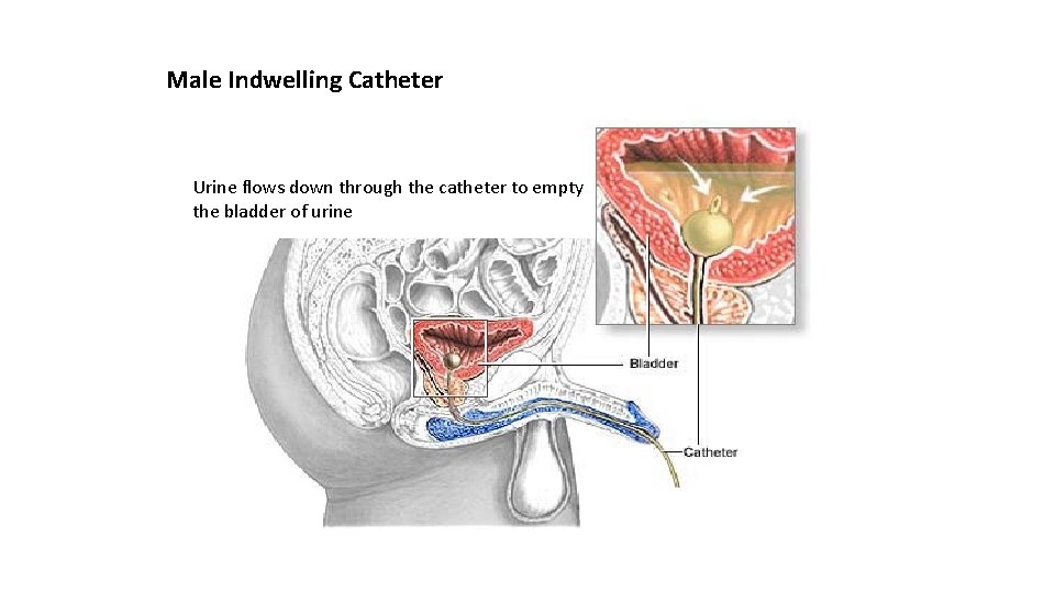 Male Indwelling Catheter Urine flows down through the catheter to empty the bladder of