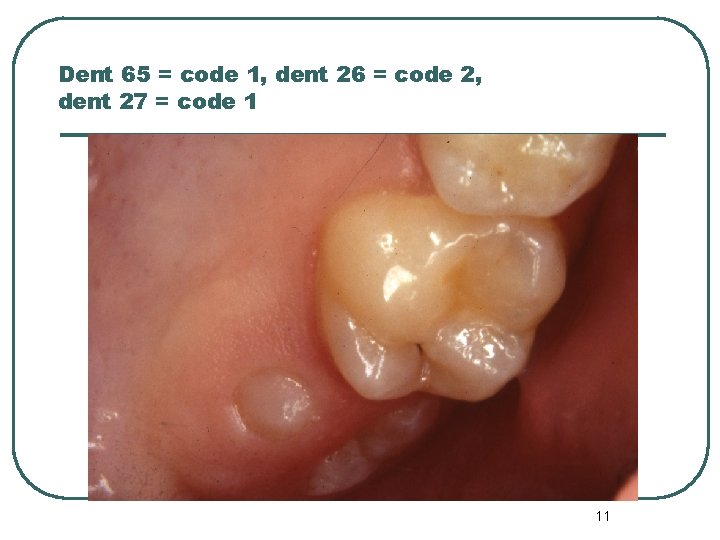Dent 65 = code 1, dent 26 = code 2, dent 27 = code Dent 65 = code 1, dent 26 = code 2, dent 27 = code