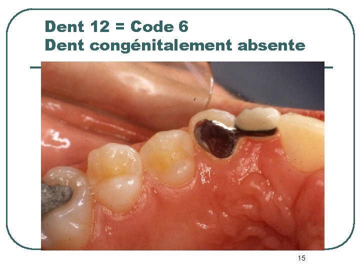 Dent 12 = Code 6 Dent congénitalement absente 15 Dent 12 = Code 6 Dent congénitalement absente 15