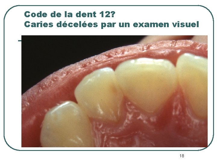 Code de la dent 12? Caries décelées par un examen visuel 18 Code de la dent 12? Caries décelées par un examen visuel 18