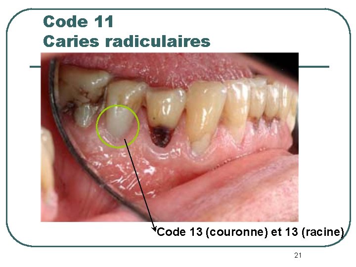 Code 11 Caries radiculaires Code 13 (couronne) et 13 (racine) 21 Code 11 Caries radiculaires Code 13 (couronne) et 13 (racine) 21