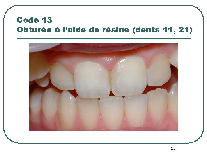 Code 13 Obturée à l’aide de résine (dents 11, 21) 22 Code 13 Obturée à l’aide de résine (dents 11, 21) 22