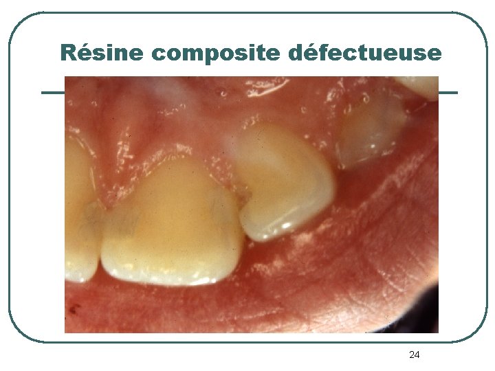 Résine composite défectueuse 24 Résine composite défectueuse 24