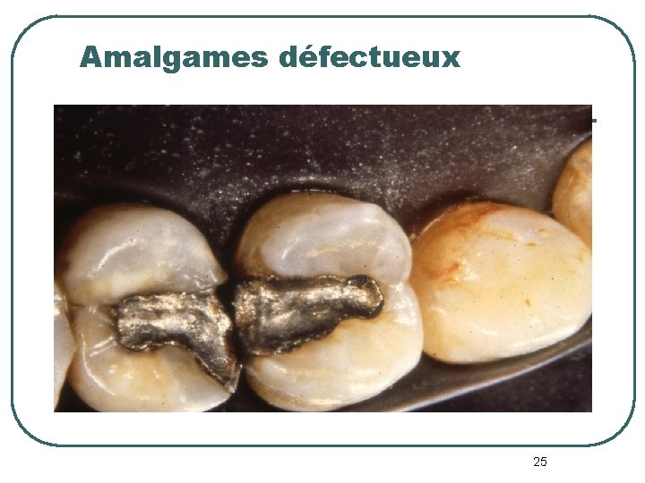 Amalgames défectueux 25 Amalgames défectueux 25