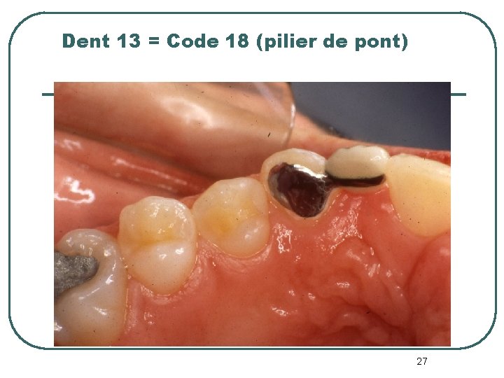 Dent 13 = Code 18 (pilier de pont) 27 Dent 13 = Code 18 (pilier de pont) 27