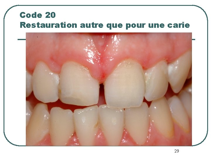 Code 20 Restauration autre que pour une carie 29 Code 20 Restauration autre que pour une carie 29