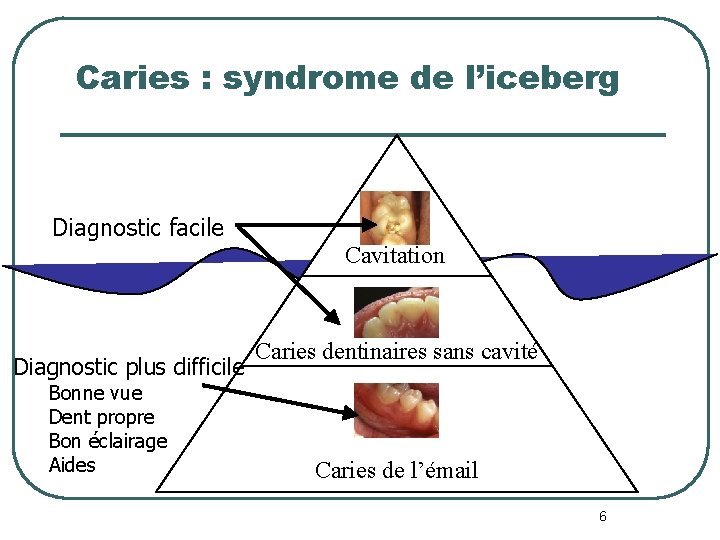 Caries : syndrome de l’iceberg Diagnostic facile Cavitation Diagnostic plus difficile Bonne vue Dent Caries : syndrome de l’iceberg Diagnostic facile Cavitation Diagnostic plus difficile Bonne vue Dent