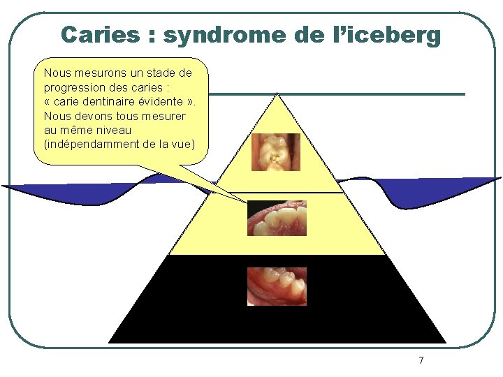 Caries : syndrome de l’iceberg Nous mesurons un stade de progression des caries : Caries : syndrome de l’iceberg Nous mesurons un stade de progression des caries :